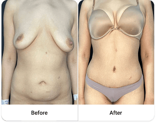 Before and after 4